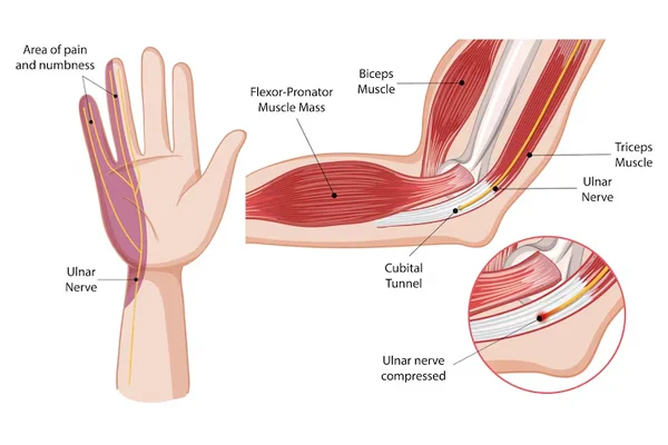 Nerve and Muscle Diseases